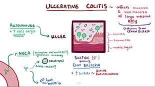 A video explaining ulcerative colitis.
