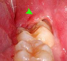 clinical shot of pericoronitis