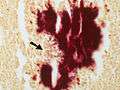 Actinomycosis - Gram stain (5285453121).jpg