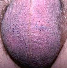 Multiple, small, blue to red papules on the scrotum