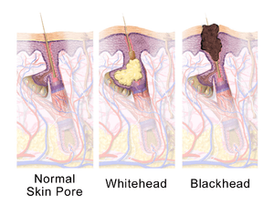 Illustration of hair follicle anatomy demonstrating a healthy hair follicle (pictured left), a whitehead or closed comedone (middle picture), and a blackhead or open comedone (pictured right)