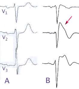 Normal electrocardiograms compared to electrocardiograms of people with Brugada Syndrome