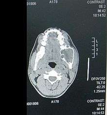  CT Scan.