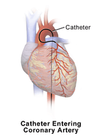 Catheter Entering Coronary Artery