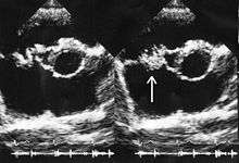Side-by-side echocardiogram cross-sections of a human heart. In the second image a white arrow points at a mass on the tricuspid valve.