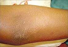 Skin-colored shiny papules on forearm with a foci of koebnerization