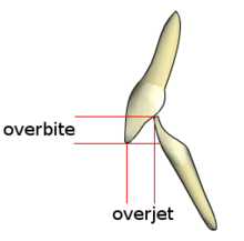 Line drawing of upper and lower teeth in an overjet arrangement.