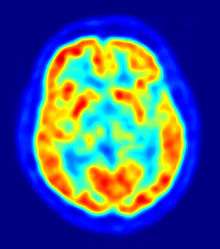 A brightly coloured blob, roughly the shape of the head sliced horizontally, on a dark blue background. Within the head is a symmetrical pattern of blobs, having the false-colours of dark blue, cyan, green, yellow and red to indicate increasing brain activity.
