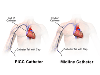 PICC vs. Midline Catheter