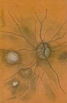 The fine blood vescles seen at the back of the eye are drawn in red and dark blue on an sandy-coloured background. There are four white blobs of various sizes, one behind and one in front of the blood vescles.