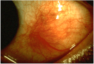In this picture, the eyeball shows a large red inflamed spot on its sclera, a symptom of scleritis, just left of the iris.