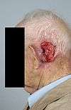 Retroauricular squamous cell carcinoma
