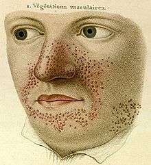 A sketch consisting only of the face and shirt collar. Across the nose, the cheeks adjacent to the nose and mouth, and the chin are numerous red pimples. Above are the words "1. Végétations vasculaires."